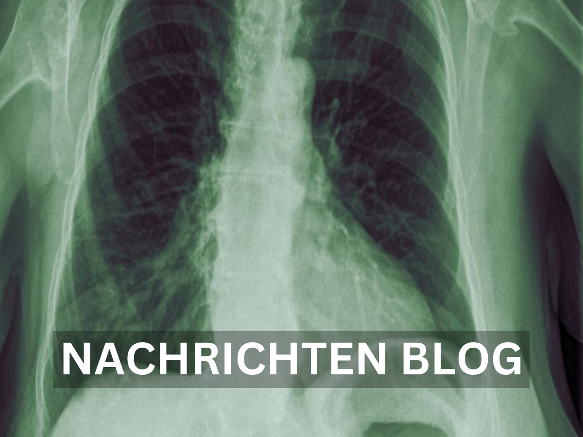 Lungenentzündung Symptome Erkennen, Verstehen und Behandeln